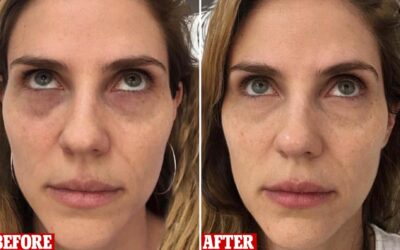 Are Under Eye Bags Permanent?