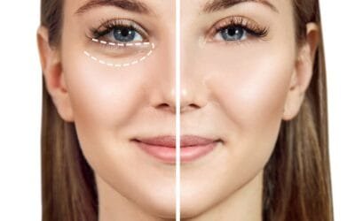 How Do You Get Rid Of Baggy Eyes Fast?