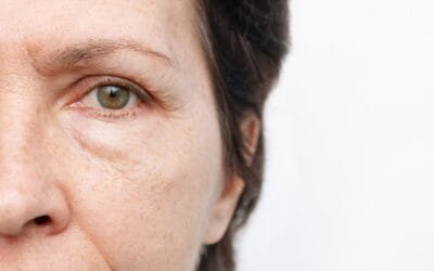 What Are Puffy Eyes A Symptom Of?