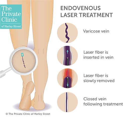 Effective Treatment Methods for Varicose Veins