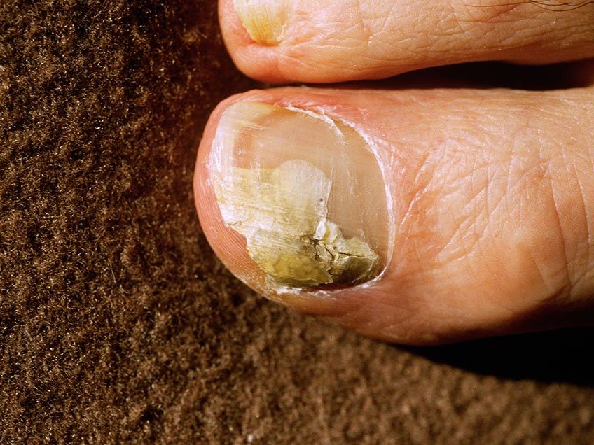 Effective Ways to Cure Nail Fungus Naturally