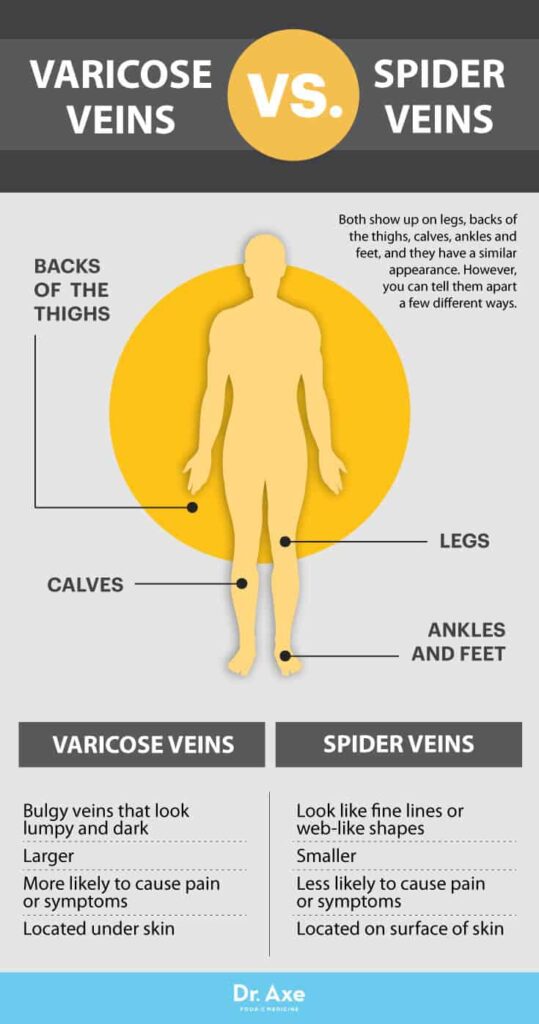 Preventing and Managing Varicose Veins Naturally