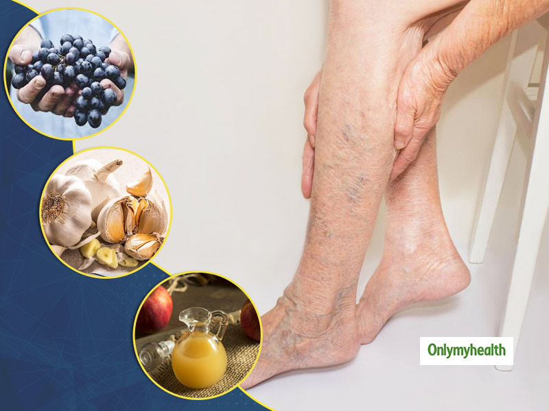 Preventing and Managing Varicose Veins Naturally