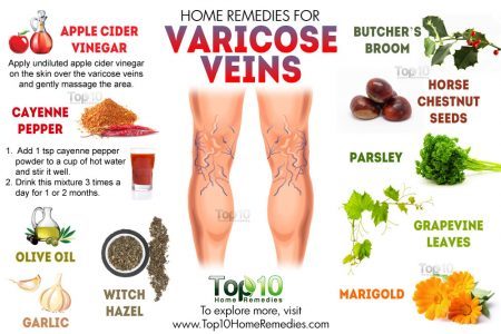 Preventing and Managing Varicose Veins Naturally