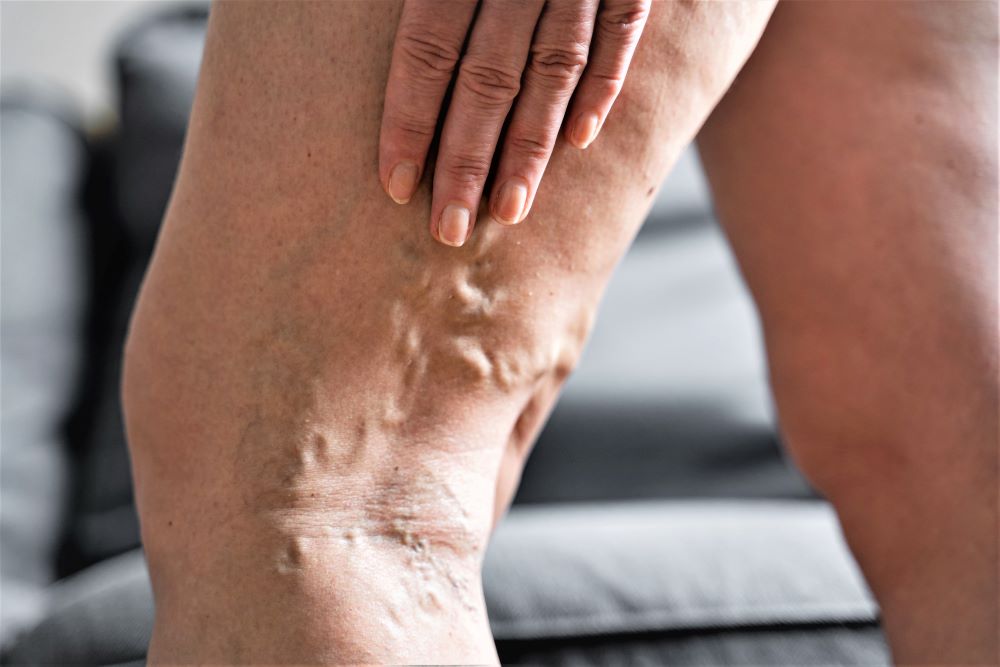 Can varicose veins disappear naturally?