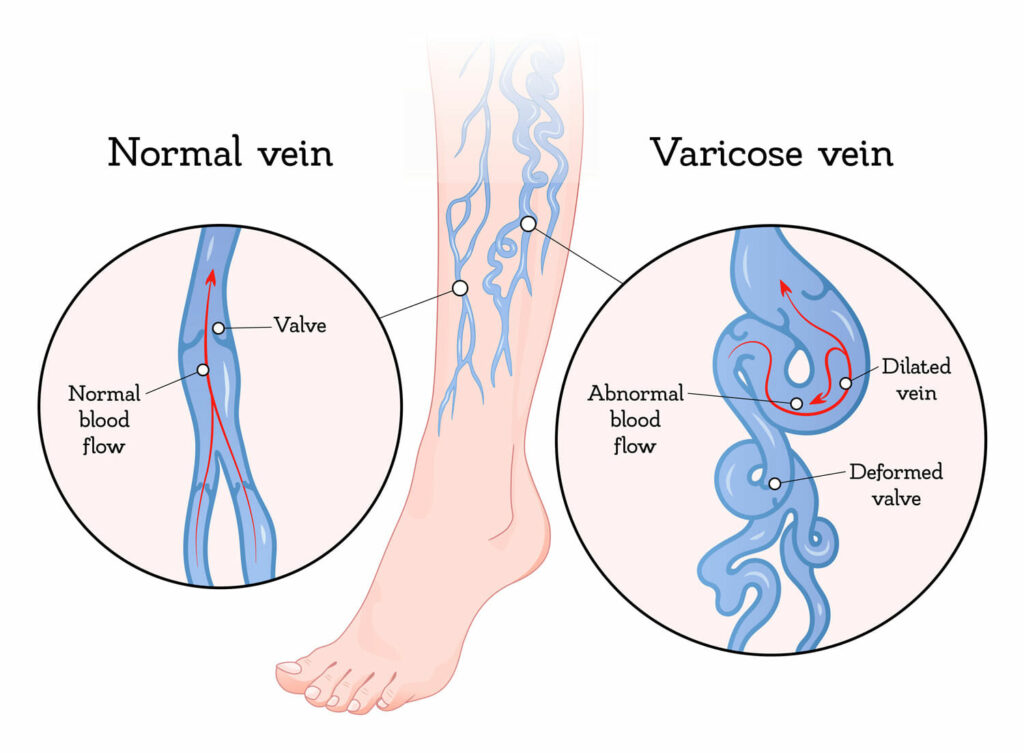 Can varicose veins disappear naturally?