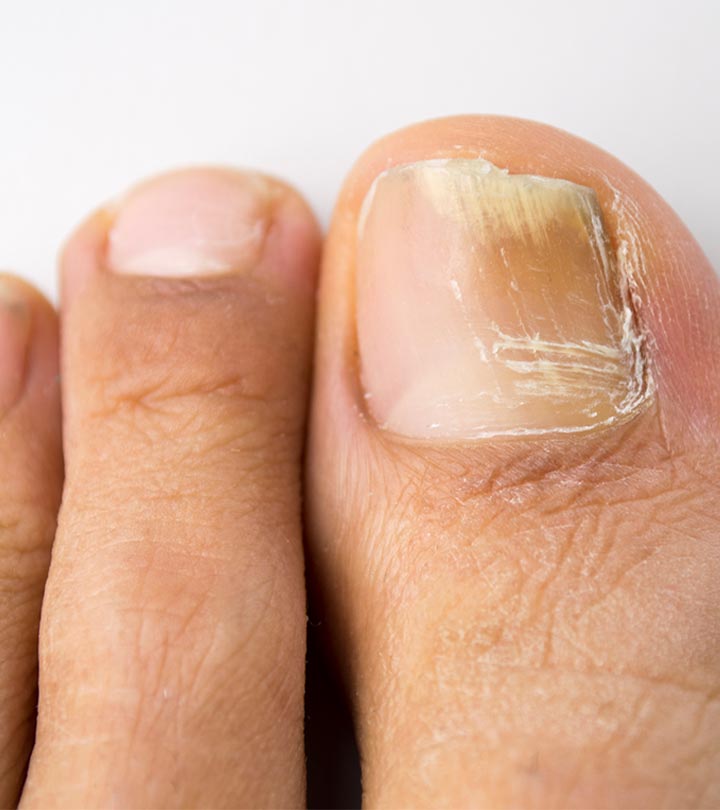 How to effectively treat toenail fungus with hydrogen peroxide