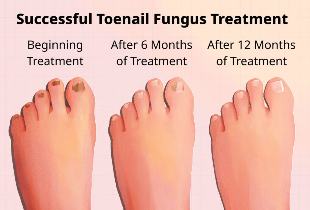 Signs that indicate toenail fungus is dying