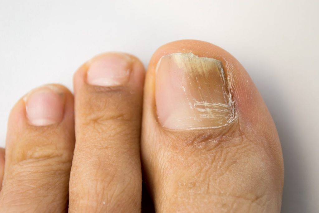 Signs that indicate toenail fungus is dying