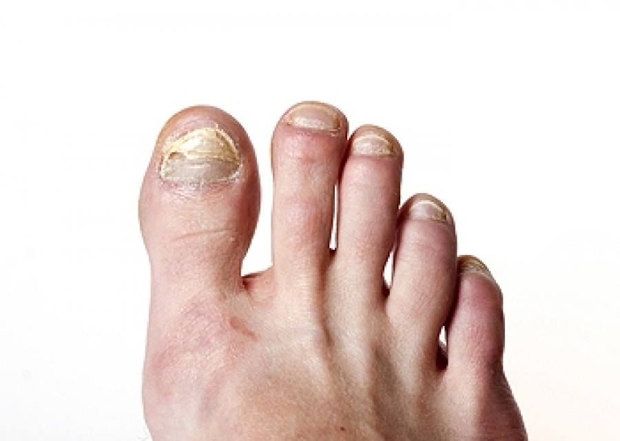 Signs that indicate toenail fungus is dying