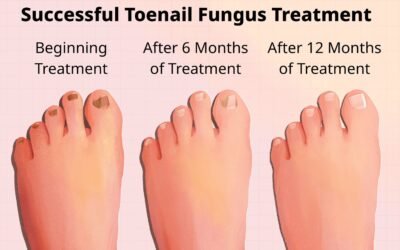 Signs that indicate toenail fungus is dying